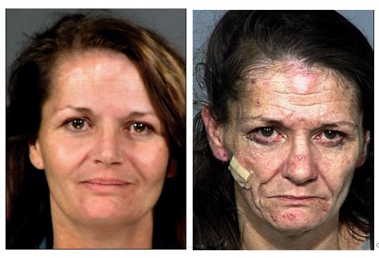 meth face before and after